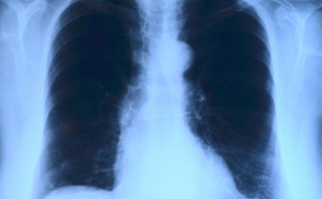 Elvégezték az országban az első tüdőverőér-tágítást
